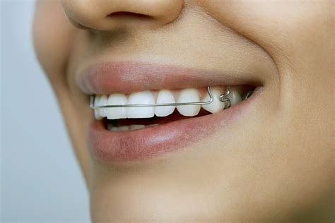 metal bracket on lower teeth how long to keep on|teeth brackets and retainer.